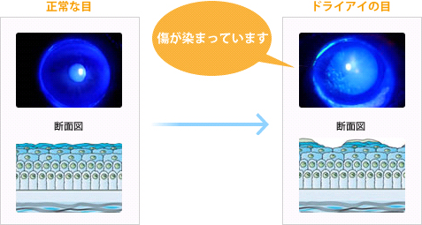ドライアイの検査方法