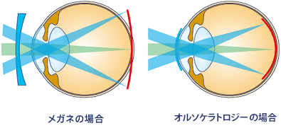 近視抑制効果のしくみ