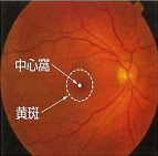 加齢黄斑変性症（AMD）