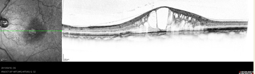 黄斑浮腫（OCT 画像）