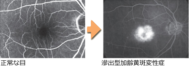 正常な目→滲出型加齢黄斑変性症