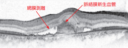 滲出型加齢黄斑変性症の黄斑像