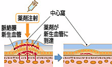 抗血管新生薬療法