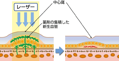 PDT（光線力学療法）とは