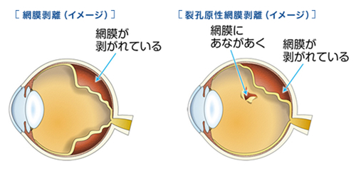 網膜剥離とは？