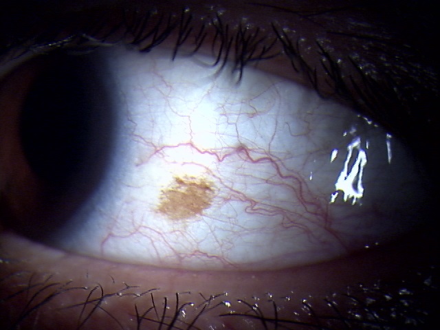 白目のシミ 結膜母斑 のレーザー治療 大阪のむさしドリーム眼科