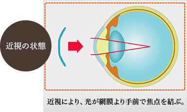 近視により、光が網膜より手前で焦点を結ぶ