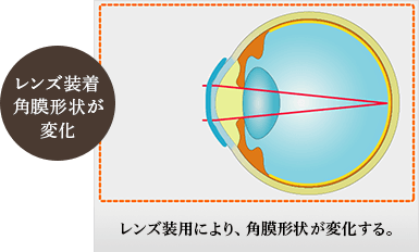 レンズ装用により、角膜形状が変化する
