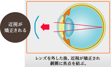 レンズを外した後、近視が矯正され網膜に焦点を結ぶ