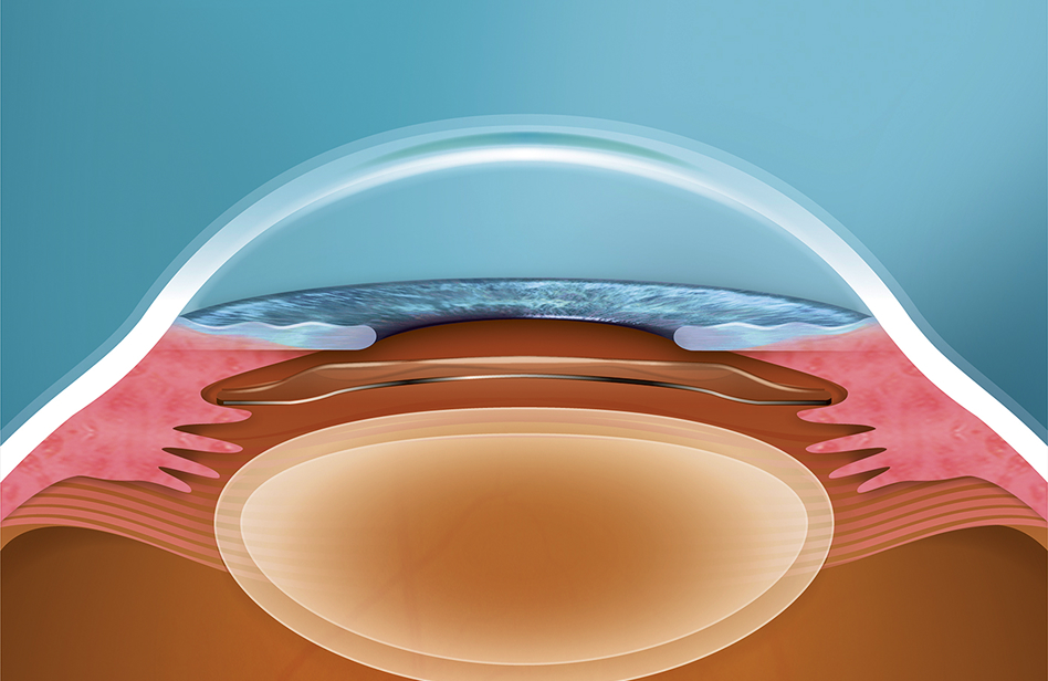 ICL/IPCL SURGERY