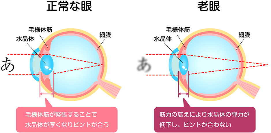 老眼（老視）とは