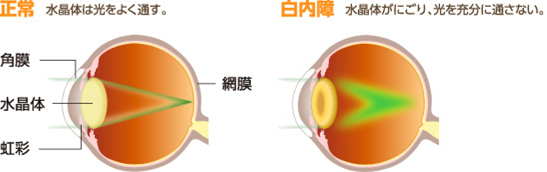 老眼（老視）と白内障の違い
