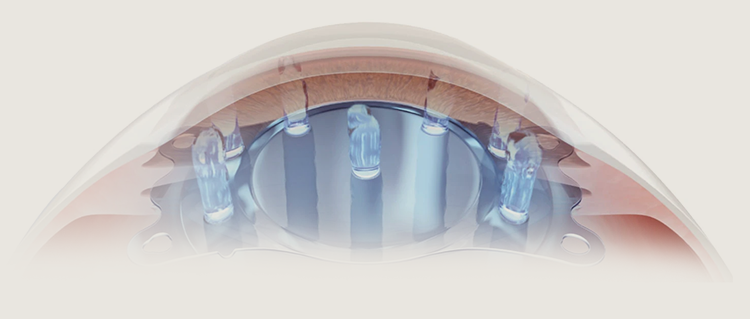 老眼用IPCL（多焦点ICL）