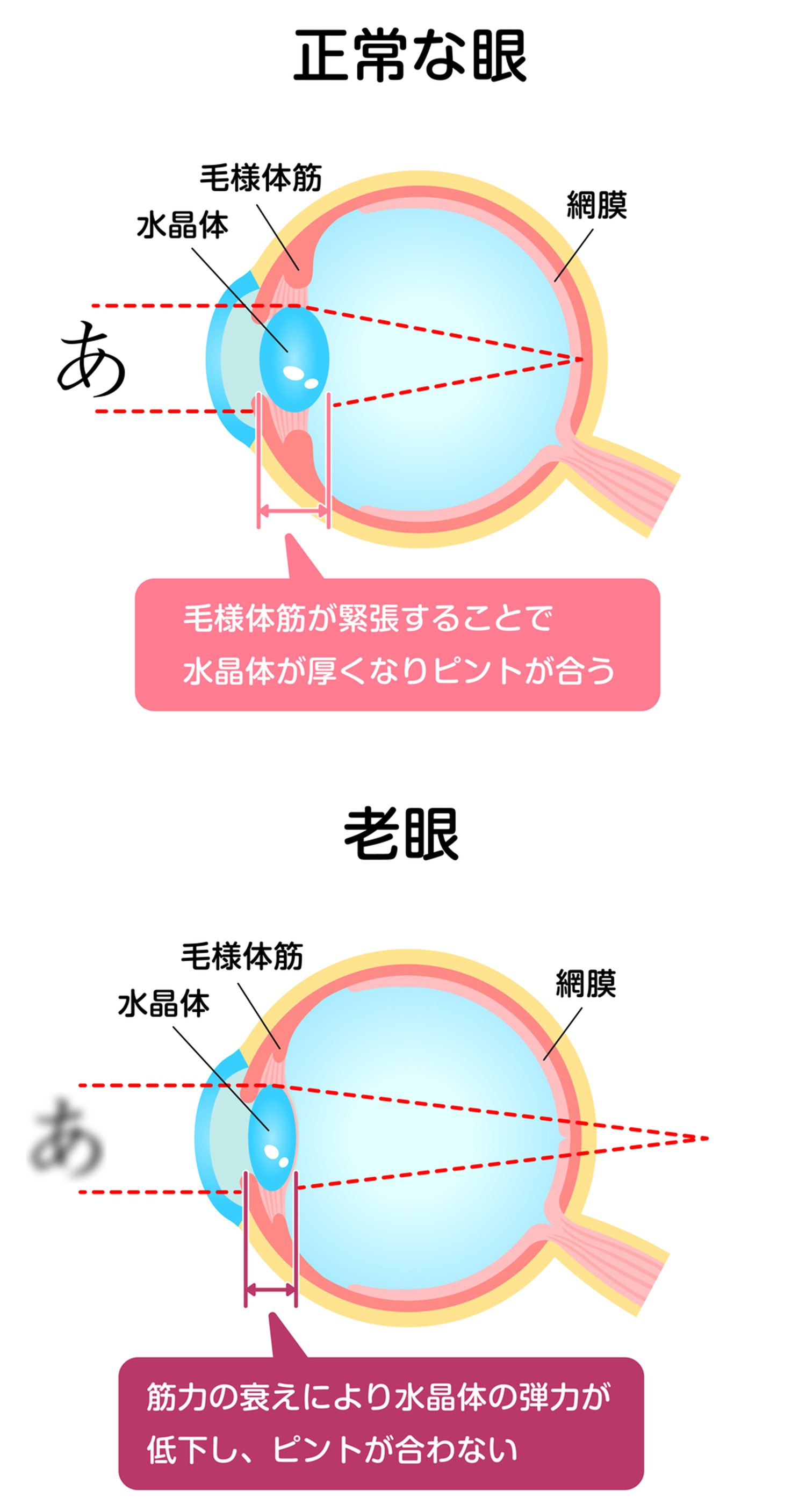 老眼（老視）とは