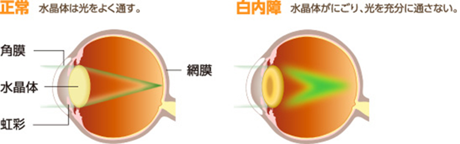 老眼（老視）と白内障の違い