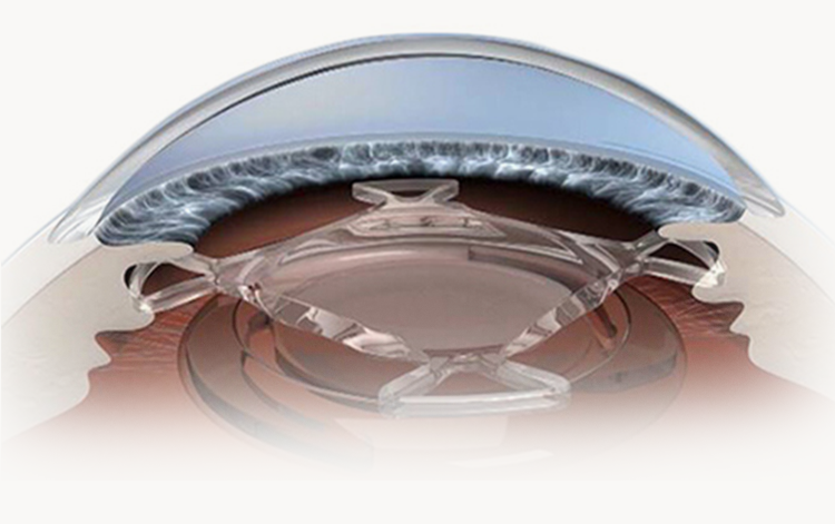 Add-on眼内レンズ